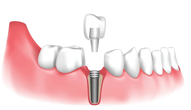 Dental Implant in Goregaon West