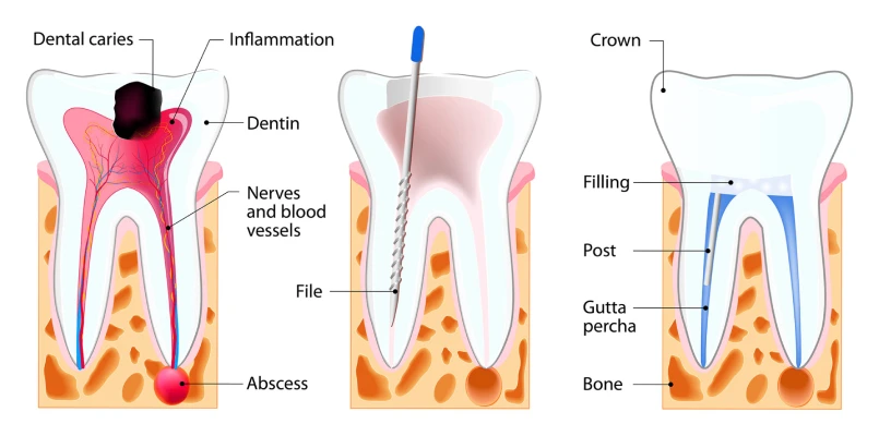 root canel treatment procedure in goregoan west