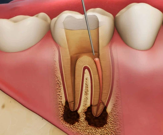 Root Canal Treatment in Goregaon West, Mumbai