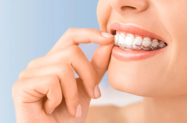 Clear Aligners Treatment in Goregaon West Clear Aligners Treatment in Goregaon West
