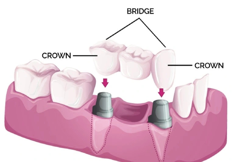 Crowns and Bridges Treatment in Goregaon West Crowns and Bridges Treatment in Goregaon West
