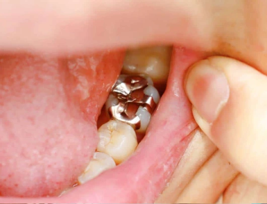 Dental Filling Treatment in Mumbai