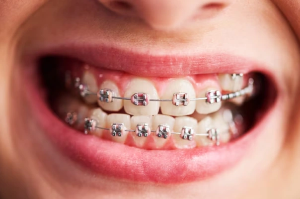 Braces Treatment Braces Treatment