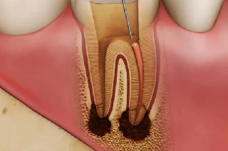 Root Canal Treatment Root Canal Treatment in Goregaon West, Mumbai