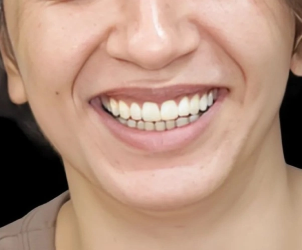 After Treatment