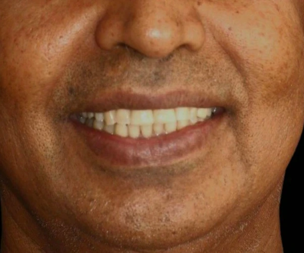 After Treatment